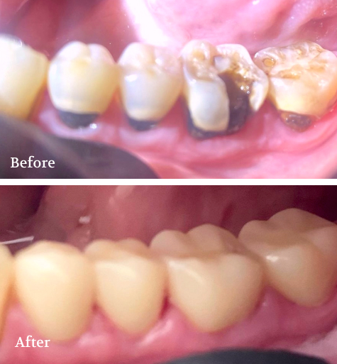 Dental Makeover Before and After Smile Showcase Collage