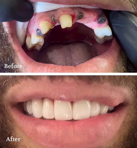 Dental Makeover collage showcase Before and After Smile