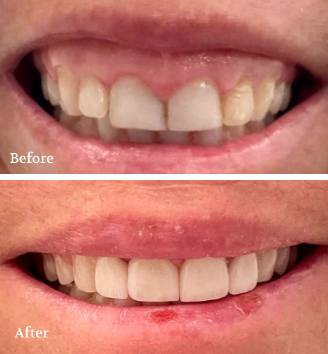 Smile Restoration Before and After Dental Work Collage