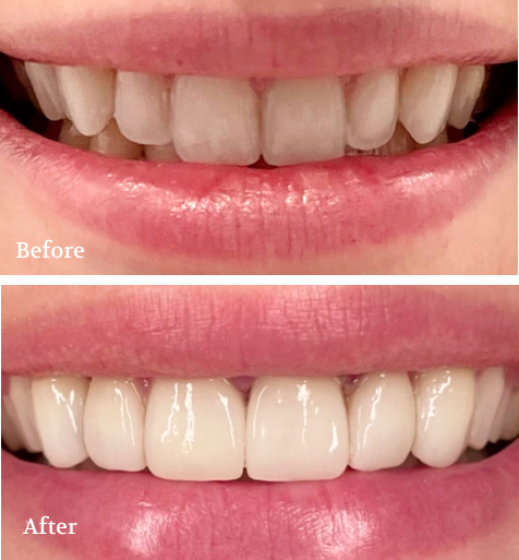 Smile Transformation Before and After Dental Makeover Collage