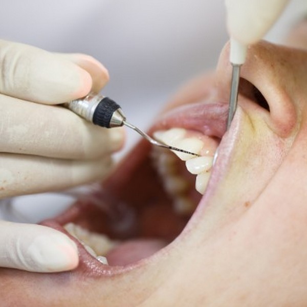 Dental procedure