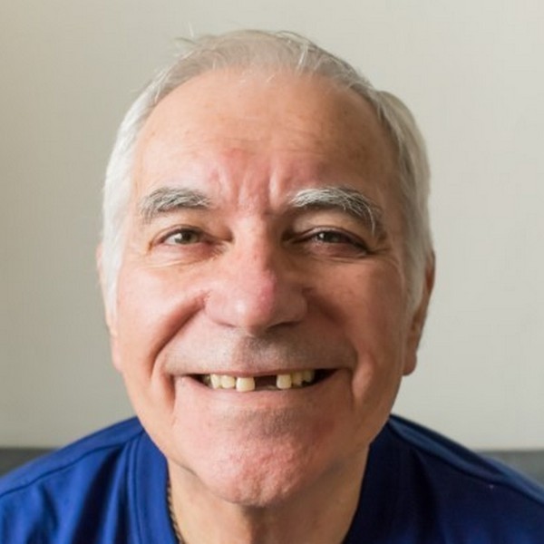 Man without several front teeth is smiling