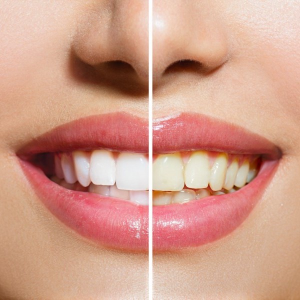 Discover The Power Of A Whiter And More Radiant Smile!