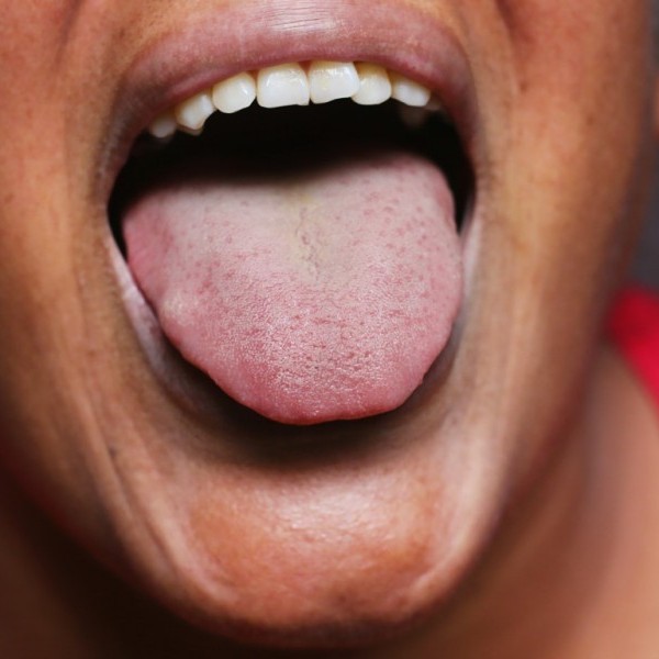 Your Tongue Can “Speak To” Your Health